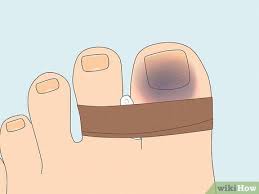 how to treat a stubbed toe 14 steps