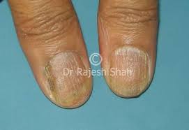 lichen pl of nails causes