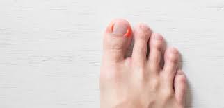 why your ingrown toenails keep coming