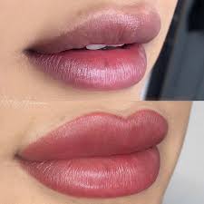 lip blush before or after fillers
