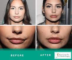 lip augmentation injections st