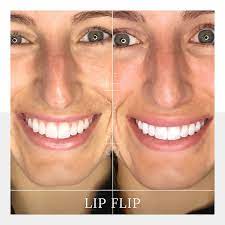 botox lip flip in dallas enhance lips