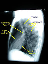 Maybe you would like to learn more about one of these? Chest X Ray