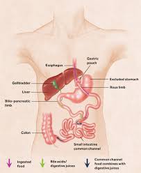 gastric byp