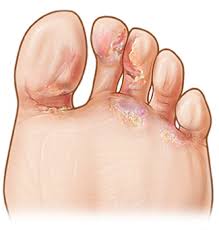 foot fungus treatment progressive