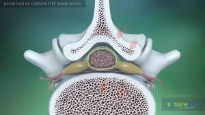 osteophytes bone spurs definition you
