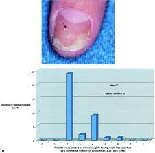 nail psoriasis severity index a useful