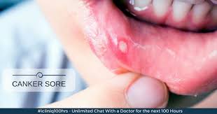 my canker sore is not healing with