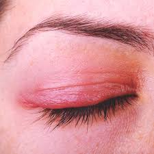 soothe an inflamed eyelid