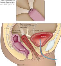 pelvic organ prolapse and ual