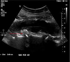 Abdominal Aortic Aneurysms Aaa Cardiovascular Disorders