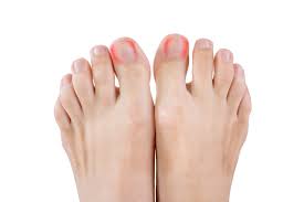 permanent ingrown toe nail treatment