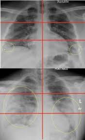 Best way to xray pictures. Chest X Rays In The Er Can Help Predict Severity Of Covid 19 In Younger Patients Imaging Technology News