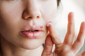herpes treating cold sores and other