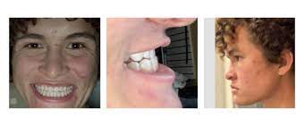 If you have too many lower teeth causing them to protrude you might fix your underbite by having the extra teeth pulled. What To Do For Underbite Class Iii Orthotropics