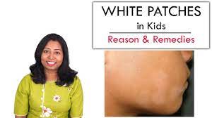 white patches in kids face reason