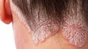 Psoriasis tends to run in families, but it may be skip generations. Apremilast Succeeds In Scalp Psoriasis Rheumnow
