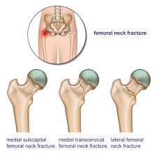 fem neck fractures joint surgeon com