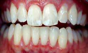 Having white spots on your teeth can be undesirable, but they are rarely a serious medical concern. Do Orthodontic Braces Cause White Spots On Teeth Directorio Odontologico