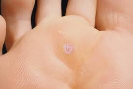 Os cravos aparecerem devido ao excesso de oleosidade da pele e acúmulo de células mortas na pele, que acabam obstruindo os poros e fazendo. O Que E Olho De Peixe E Como Identificar Sintomas E Fotos Tua Saude