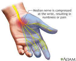 carpal tunnel syndrome information