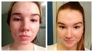 how i cleared my acne before after