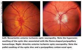 These are differentiated by the part of the optic nerve head that is affected. Diagnosing And Managing Ischemic Optic Neuropathy