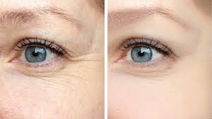 how to manage under eye wrinkles and