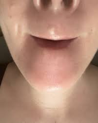 remove a cyst on my upper lip