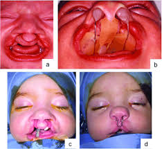 complete cleft lip and palate bclp