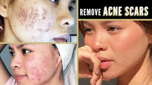 how to get rid of acne scars fast