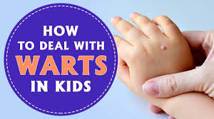how to deal with warts in children