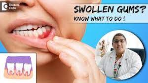 what swollen gums are telling you know
