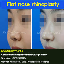 flat nose rhinoplasty