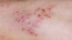 Goyal h., thakkar n., bagheri f., srivastava s. Meningitis Symptoms Causes Types Treatment Risks More