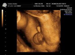 Alles zur größe des babys, der entwicklung, anzeichen und bauch der doch es ist noch viel zu früh, um das geschlecht im ultraschall erkennen zu können. Bilder Cueto Frauenaerzte Koln