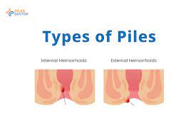 diffe types of piles hemorrhoids