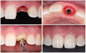 single tooth dental implant the best