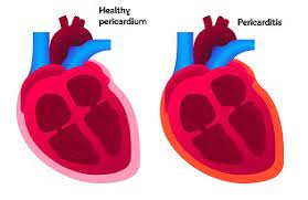 In both cases, the body's immune system causes inflammation in response to an infection or some other trigger. Pericarditis Causes Symptoms Treatment British Heart Foundation