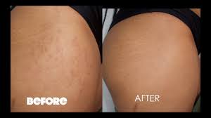 cover your stretch marks for summer