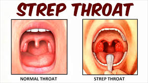 strep throat you