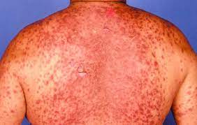 After this, your doctor may gradually increase your dose as needed. Lamictal Rash Symptom Treatment And Complications