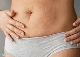 the top 10 effective stretch marks