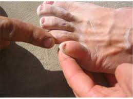 shortest pinky toenail world record