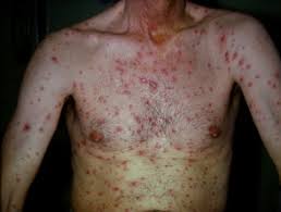 Syphilis is a bacterial infection usually spread by sexual contact. Syphilis Dermnet Nz
