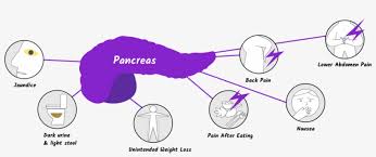 Pancreatic cancer occurs when cancer cells form and grow within the pancreas. Pancreatic Cancer Symptoms With Seven Symptom Icons Pancreatic Cancer Diagnosis Png Image Transparent Png Free Download On Seekpng