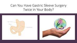gastric sleeve surgery twice