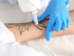 Laser Tattoo Removal Guide Form | Victoria's