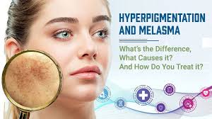 hyperpigmentation and melasma