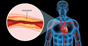 Can High Cholesterol Cause Joint, Armpits, or Back pain?